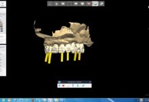 Framework in Metallo su Impianti (Video)