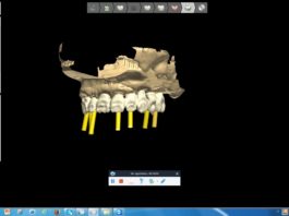Framework in Metallo su Impianti (Video)