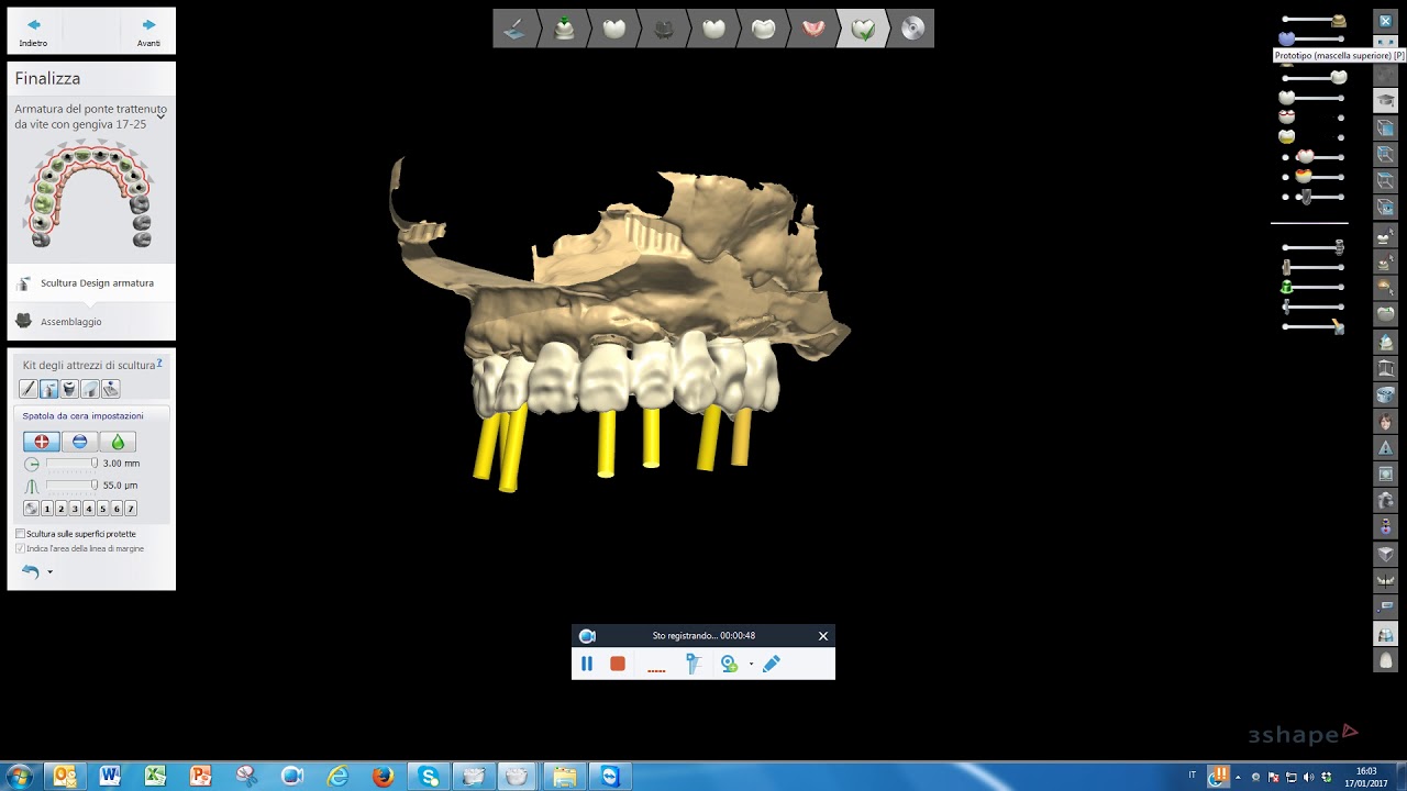 Framework in Metallo su Impianti (Video)
