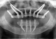 Giunto implantare: Tensioni che determinano la perdita di un impianto.
