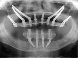 Giunto implantare: Tensioni che determinano la perdita di un impianto.