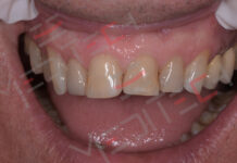 Faccetta in Disilicato di Litio