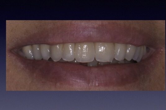 Progettazione ed esecuzione di un Framework in Zirconio