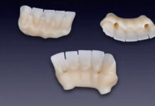 Framework in Zirconio su monconi implantari- tecnica dell’incollaggio