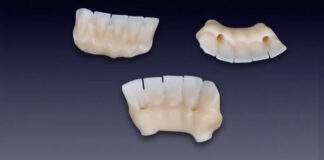 Framework in Zirconio su monconi implantari- tecnica dell’incollaggio