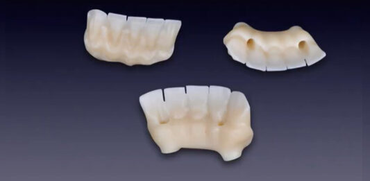Framework in Zirconio su monconi implantari- tecnica dell’incollaggio