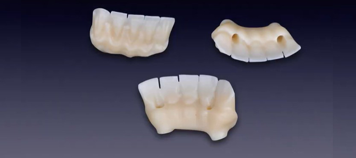 Framework in Zirconio su monconi implantari- tecnica dell’incollaggio