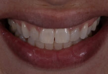 NUOVE LINEE GUIDA PER LE FACCETTE IN COMPOSITO ADESIVE