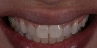 NUOVE LINEE GUIDA PER LE FACCETTE IN COMPOSITO ADESIVE