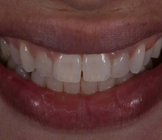 NUOVE LINEE GUIDA PER LE FACCETTE IN COMPOSITO ADESIVE