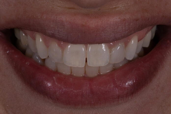 linee_guida_faccette_composito_adesive13_copertina